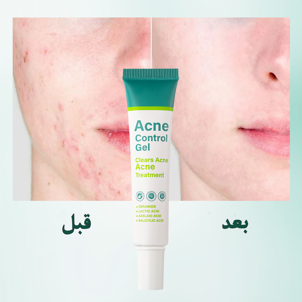 الجال الموضعي السحري لعلاج حب الشباب Acne Control Gel